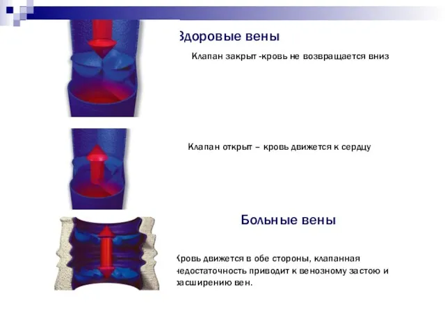 Здоровые вены Клапан закрыт -кровь не возвращается вниз Клапан открыт