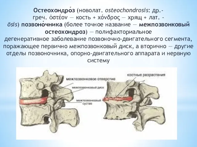 Остеохондро́з (новолат. osteochondrosis: др.-греч. ὀστέον — кость + χόνδρος —