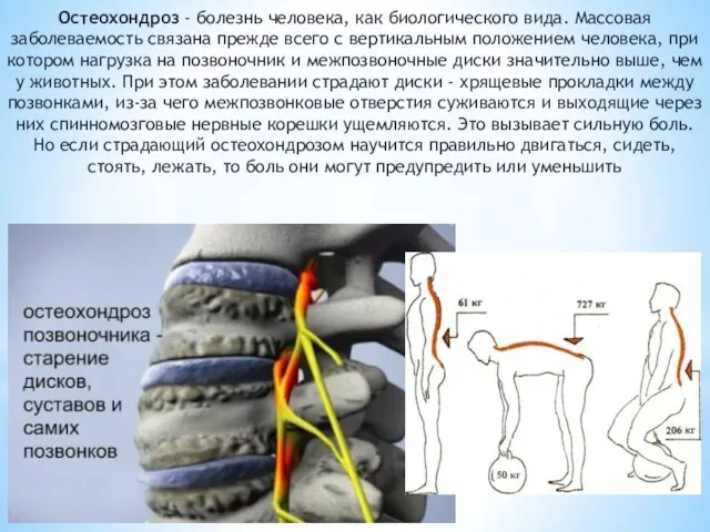 Остеохондроз - болезнь человека, как биологического вида. Массовая заболеваемость связана