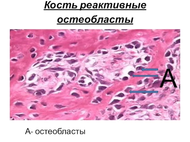 Кость реактивные остеобласты А- остеобласты А