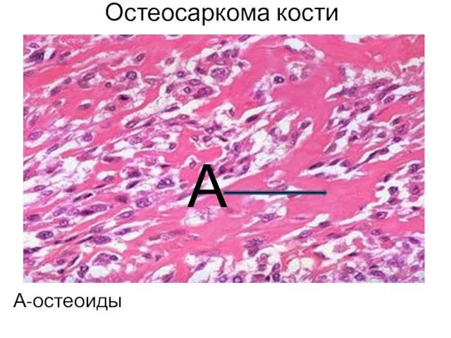 Остеосаркома кости А-остеоиды А