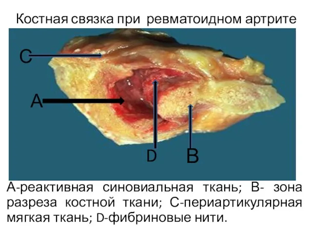 Костная связка при ревматоидном артрите А-реактивная синовиальная ткань; В- зона