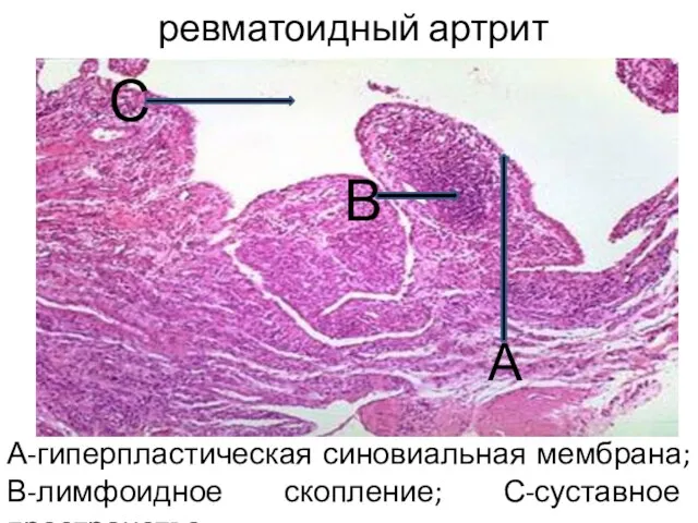 ревматоидный артрит А-гиперпластическая синовиальная мембрана; В-лимфоидное скопление; С-суставное пространство А В С