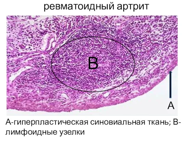 ревматоидный артрит А-гиперпластическая синовиальная ткань; В-лимфоидные узелки А В