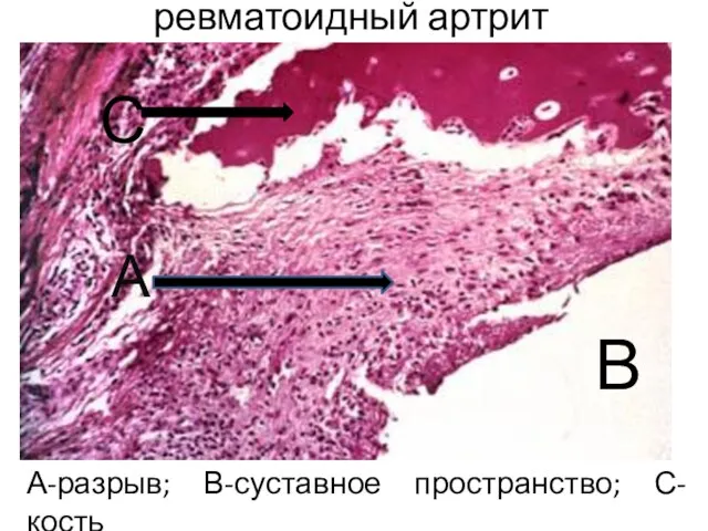 ревматоидный артрит А-разрыв; В-суставное пространство; С-кость А В С