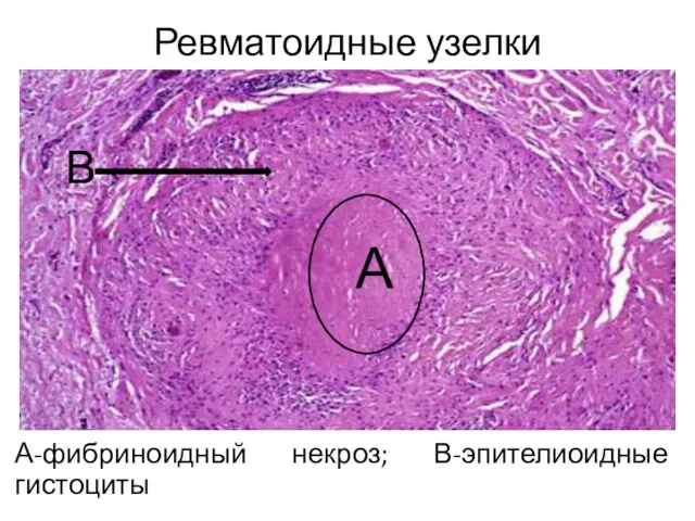 Ревматоидные узелки А-фибриноидный некроз; В-эпителиоидные гистоциты А В