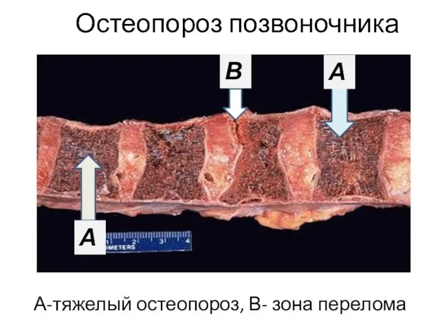 Остеопороз позвоночника А-тяжелый остеопороз, В- зона перелома А А В