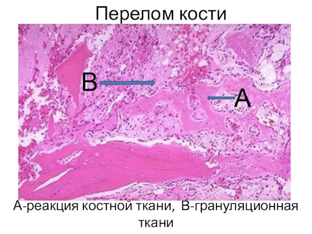 Перелом кости А-реакция костной ткани, В-грануляционная ткани А В