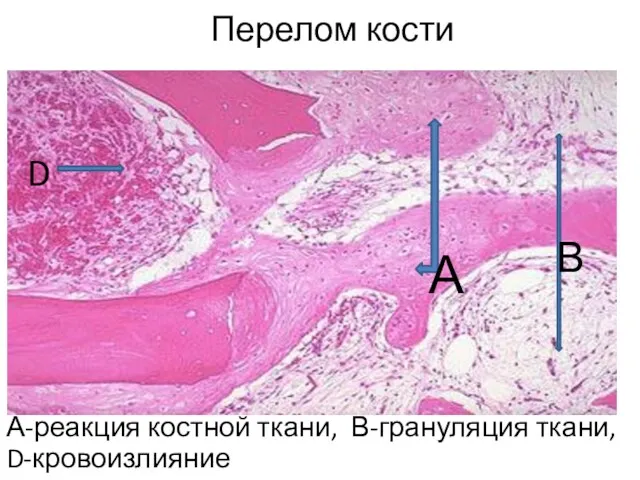 Перелом кости А-реакция костной ткани, В-грануляция ткани, D-кровоизлияние А D В
