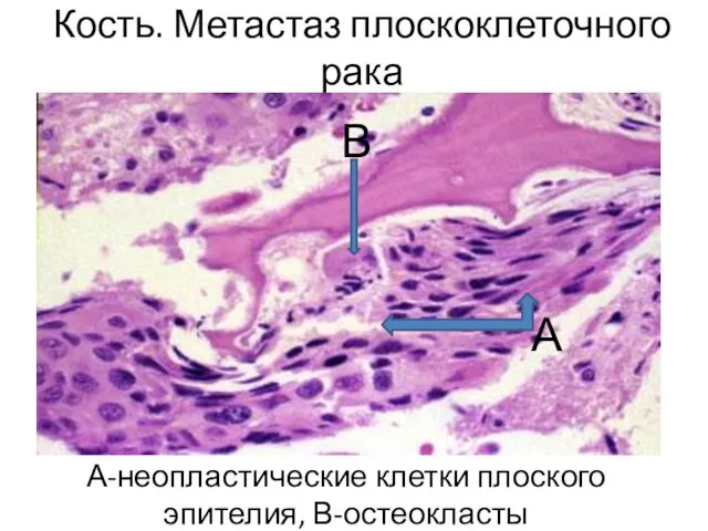 Кость. Метастаз плоскоклеточного рака А-неопластические клетки плоского эпителия, В-остеокласты А В