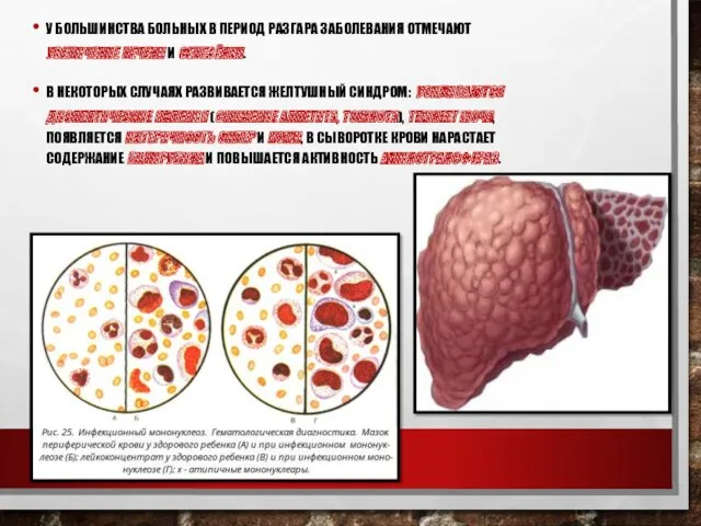 У БОЛЬШИНСТВА БОЛЬНЫХ В ПЕРИОД РАЗГАРА ЗАБОЛЕВАНИЯ ОТМЕЧАЮТ УВЕЛИЧЕНИЕ ПЕЧЕНИ