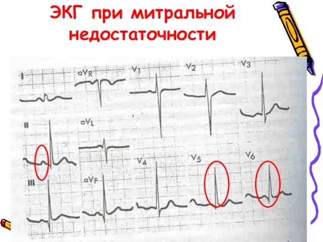 ЭКГ при митральной недостаточности