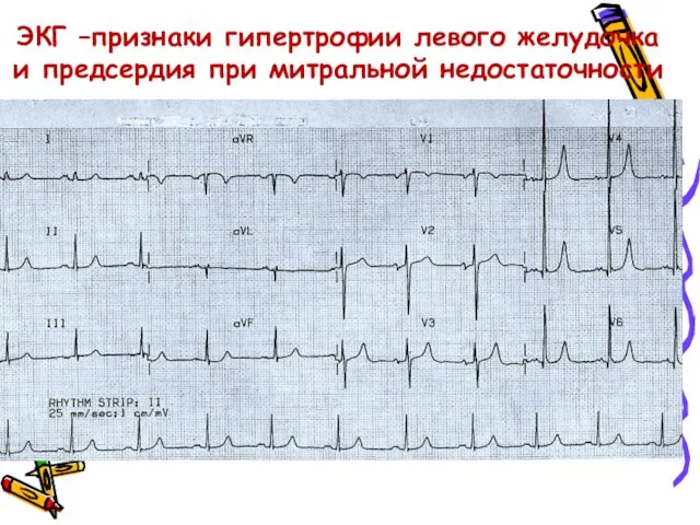 ЭКГ –признаки гипертрофии левого желудочка и предсердия при митральной недостаточности