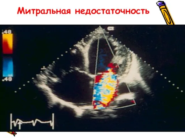 Митральная недостаточность