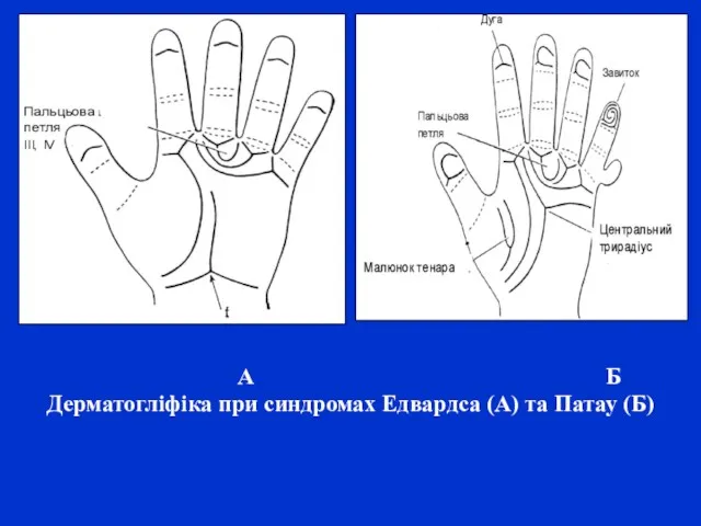 А Б Дерматогліфіка при синдромах Едвардса (А) та Патау (Б)