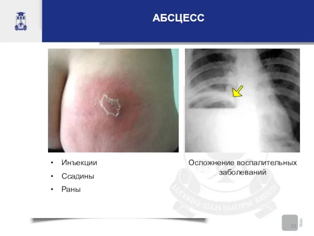 АБСЦЕСС Инъекции Ссадины Раны Осложнение воспалительных заболеваний