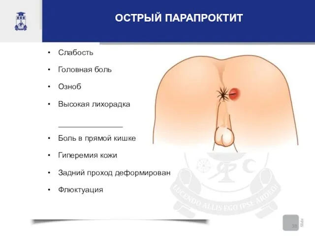 ОСТРЫЙ ПАРАПРОКТИТ Слабость Головная боль Озноб Высокая лихорадка Боль в