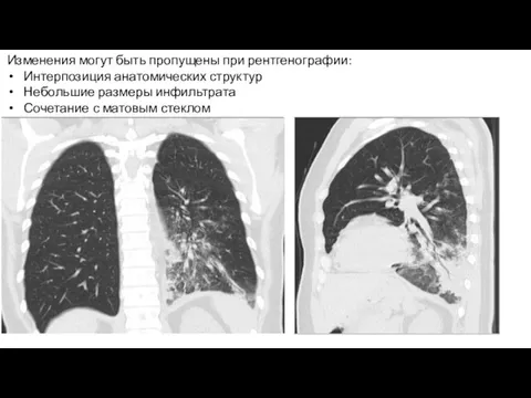 H. Influenza внебольничная пневмония Изменения могут быть пропущены при рентгенографии: