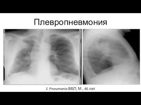 Плевропневмония S. Pneumonia ВБП, М., 46 лет