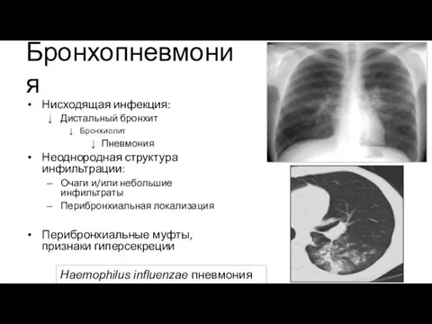 Бронхопневмония Нисходящая инфекция: Дистальный бронхит Бронхиолит Пневмония Неоднородная структура инфильтрации: