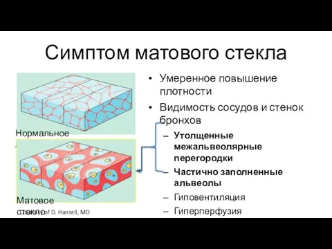 Нормальное легкое Матовое стекло Courtesy of D. Hansell, MD Симптом