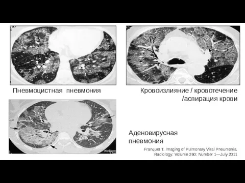 Пневмоцистная пневмония Кровоизлияние / кровотечение /аспирация крови Аденовирусная пневмония Franquet