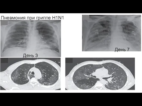 День 3 День 7 Пневмония при гриппе H1N1