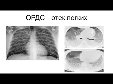 ОРДС – отек легких