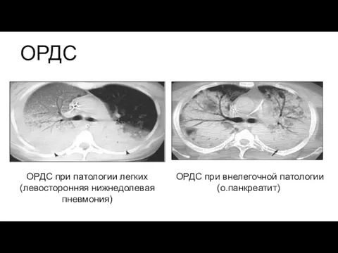 ОРДС ОРДС при патологии легких (левосторонняя нижнедолевая пневмония) ОРДС при внелегочной патологии (о.панкреатит)