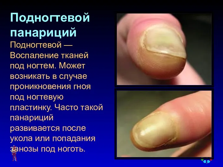 Подногтевой панариций Подногтевой — Воспаление тканей под ногтем. Может возникать в случае проникновения