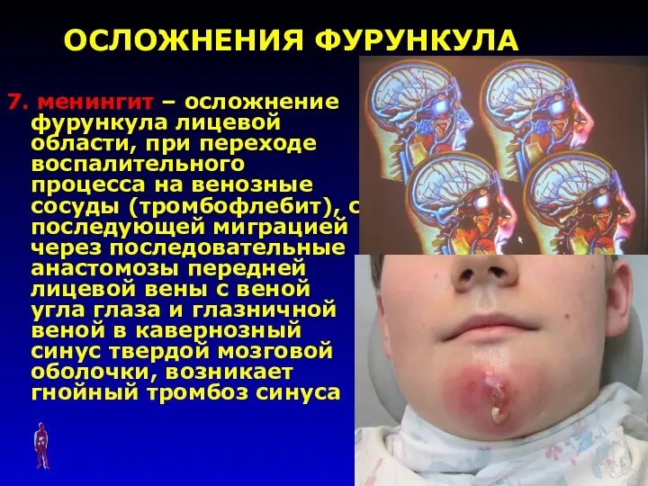 ОСЛОЖНЕНИЯ ФУРУНКУЛА 7. менингит – осложнение фурункула лицевой области, при переходе воспалительного процесса