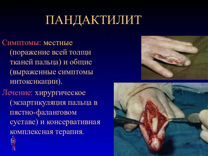 ПАНДАКТИЛИТ Симптомы: местные (поражение всей толщи тканей пальца) и общие (выраженные симптомы интоксикации).