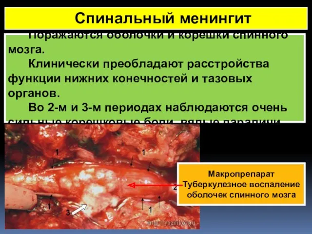 Поражаются оболочки и корешки спинного мозга. Клинически преобладают расстройства функции