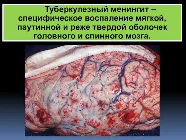 Туберкулезный менингит – cпецифическое воспаление мягкой, паутинной и реже твердой оболочек головного и спинного мозга.