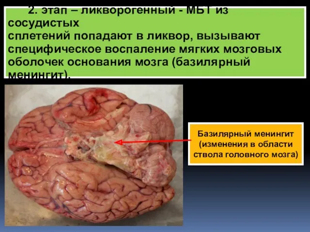 2. этап – ликворогенный - МБТ из сосудистых сплетений попадают