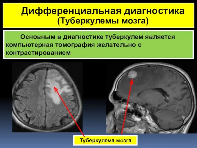 Основным в диагностике туберкулем является компьютерная томография желательно с контрастированием Туберкулема мозга Дифференциальная диагностика (Туберкулемы мозга)