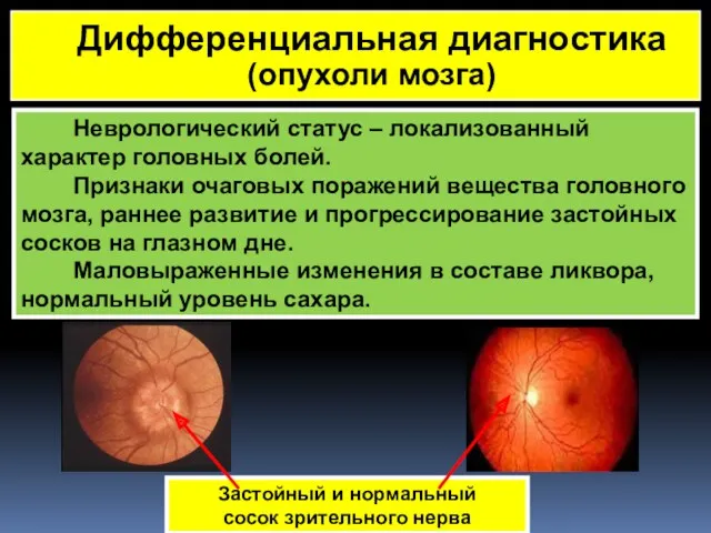 Неврологический статус – локализованный характер головных болей. Признаки очаговых поражений