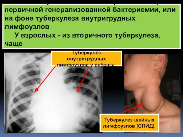 У детей тубменингит может развиться при первичной генерализованной бактериемии, или