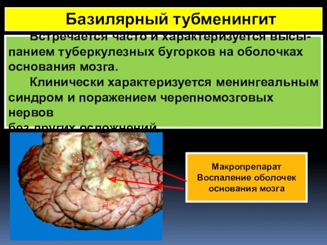 Встречается часто и характеризуется высы- панием туберкулезных бугорков на оболочках