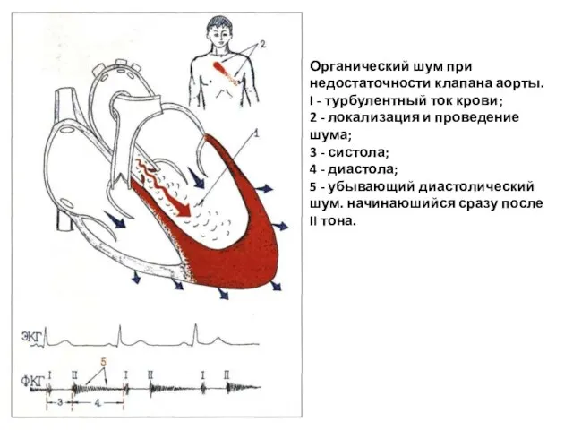 Органический шум при недостаточности клапана аорты. I - турбулентный ток