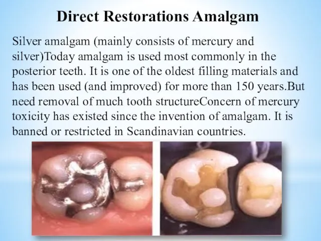 Silver amalgam (mainly consists of mercury and silver)Today amalgam is used most commonly