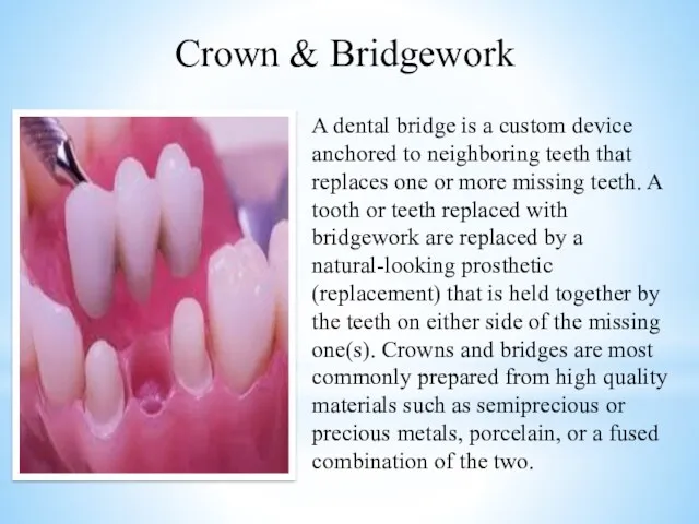 A dental bridge is a custom device anchored to neighboring teeth that replaces