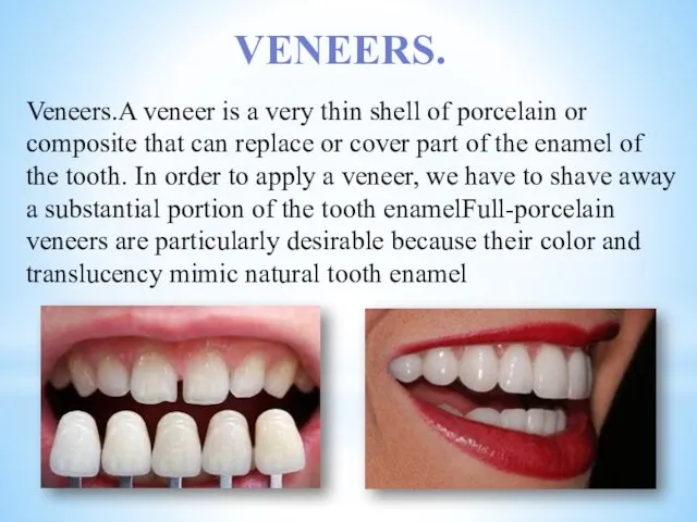 Veneers.A veneer is a very thin shell of porcelain or