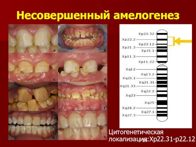 Несовершенный амелогенез Цитогенетическая локализация:Xp22.31-p22.12