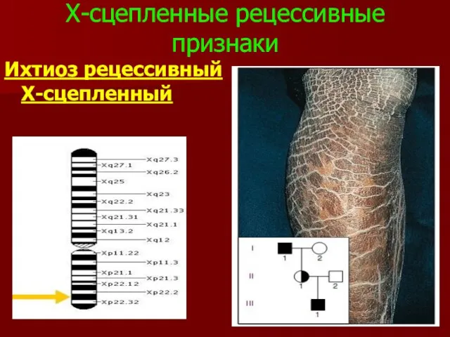 Х-сцепленные рецессивные признаки Ихтиоз рецессивный Х-сцепленный