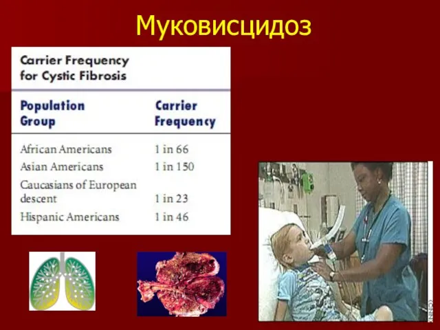 Муковисцидоз