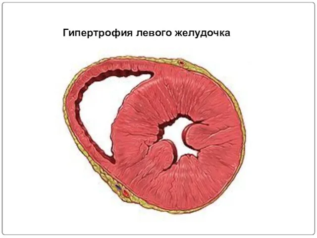 Гипертрофия левого желудочка