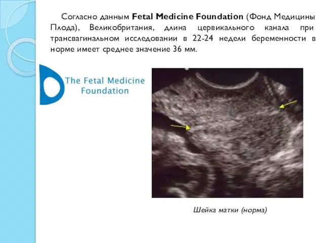 Согласно данным Fetal Medicine Foundation (Фонд Медицины Плода), Великобритания, длина цервикального канала при