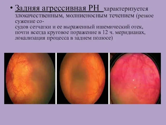 Задняя агрессивная РН характеризуется злокачественным, молниеносным течением (резкое сужение со-