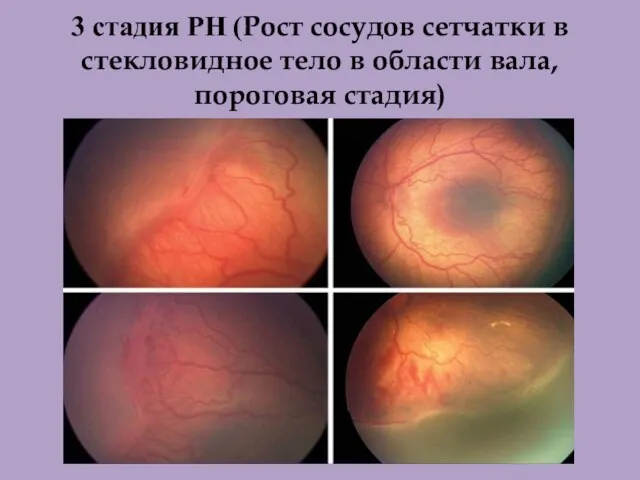 3 стадия РН (Рост сосудов сетчатки в стекловидное тело в области вала, пороговая стадия)